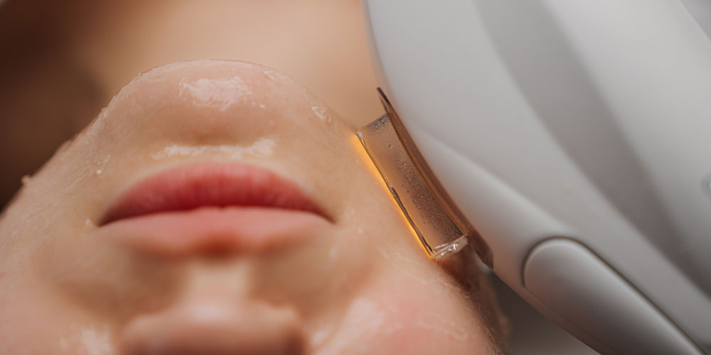 IPL therapy uses broad-spectrum light to treat various skin concerns, including pigmentation, redness, and sun damage. Pulses of light are delivered to the skin, targeting pigment and blood vessels to improve skin tone and texture. Improved skin tone, reduced pigmentation and redness. Multiple treatments may be needed for optimal results.
