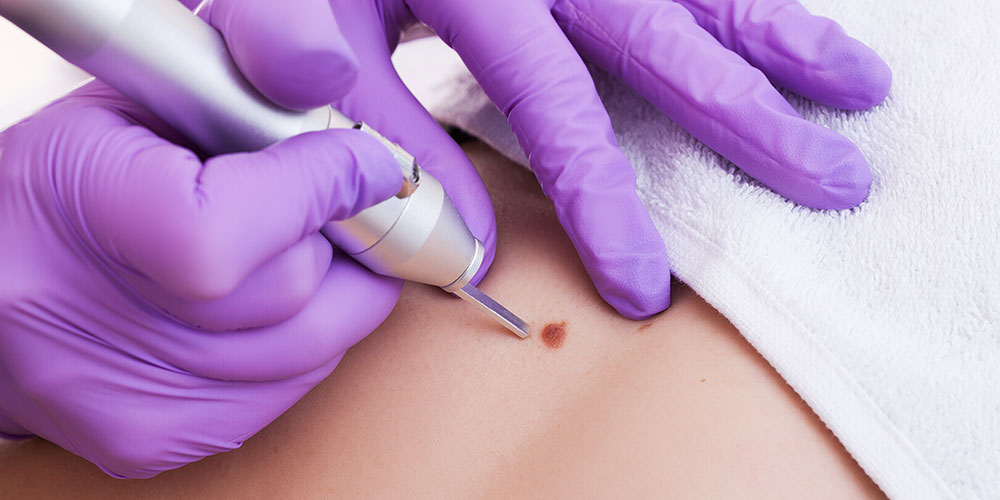 The Lamprobe® machine utilizes radiofrequency energy to remove a variety of benign skin lesions with minimal scarring. Treatments may require topical or local anesthetic injections. The treatment area is cleaned and each individual lesion treated with a fine probe. Removal or significant reduction of treated skin lesions.